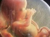 卵巢囊肿卵子排不出来是一样的吗？二者有什么关联？